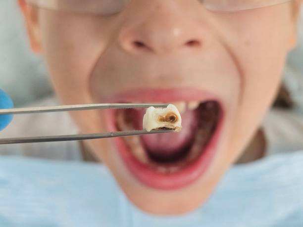 Best Emergency Dental Filling Replacement  in Sinton, TX